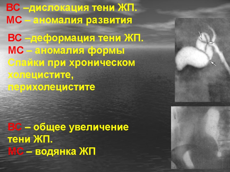 ВС –дислокация тени ЖП. МС – аномалия развития      